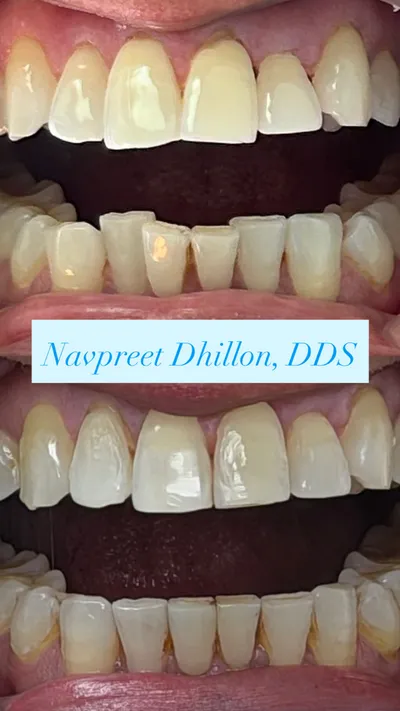 Before and after dental treatment from Dhillon Dental's smile gallery