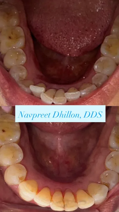 Before and after lower teeth alignment from Dhillon Dental's smile gallery